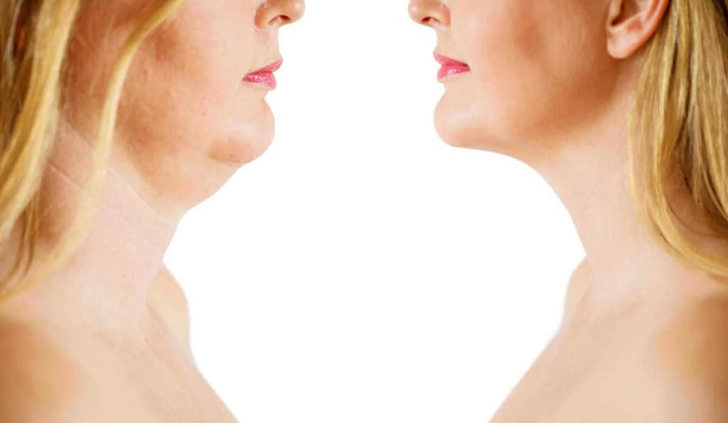Double Chin treatment Chessington before and after results