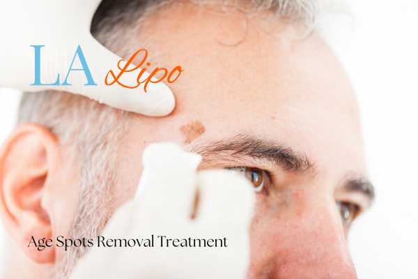 What Are the Most Effective Treatments for Age Spots Chessington?