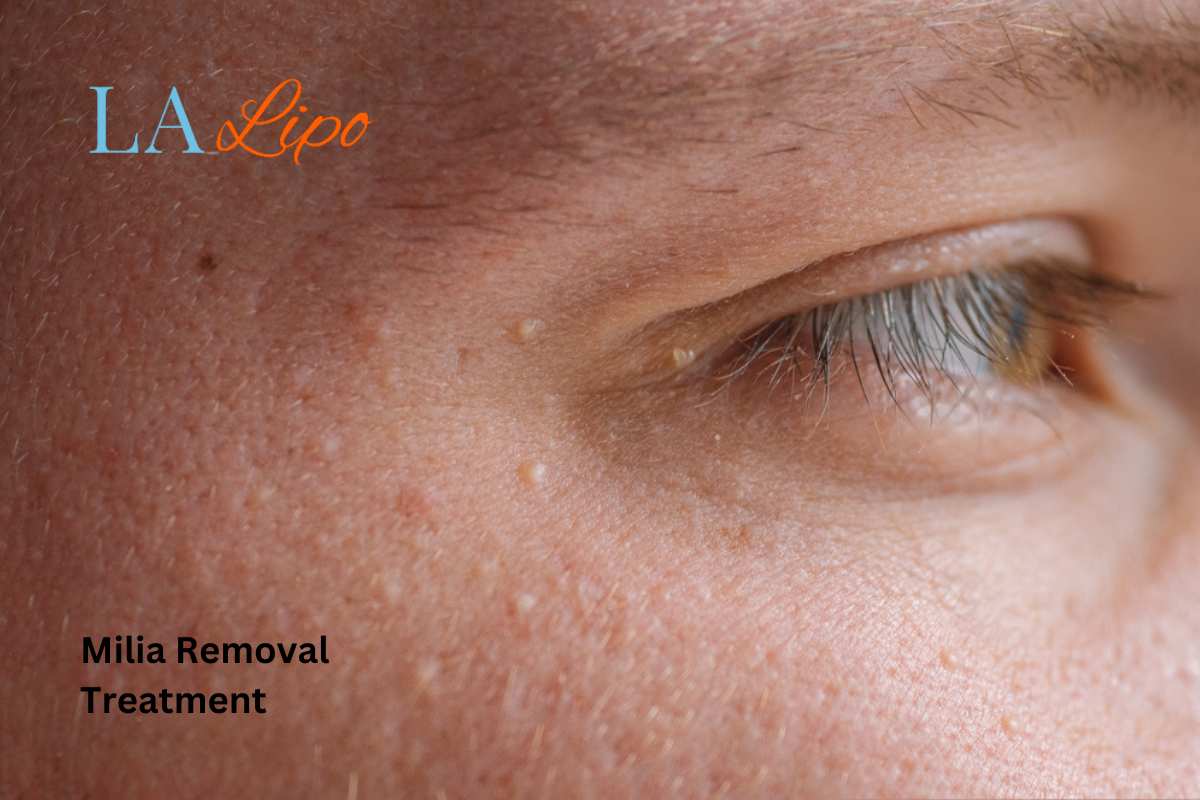 Cryopen Milia Removal: Is It the Easiest and Safest Option Chessington?