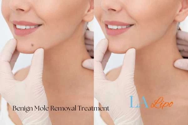 woman's before and after mole removal Chessington results