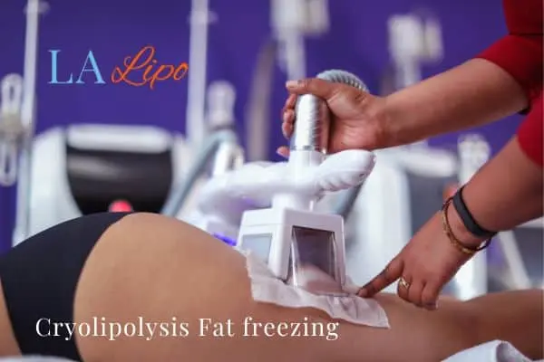 women getting fat freezing Chessington