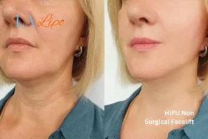 hi-fu for wrinkles Chessington before and after results