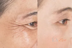 Before and after results of woman - HI-fu wrinkles reduction treatment Chessington