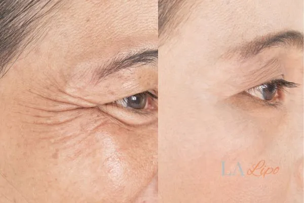 Before and after results of woman - HI-fu wrinkles reduction treatment Chessington