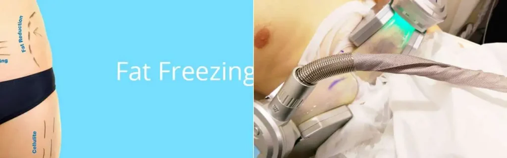 Fat freezing Chessington on multiple areas of the body