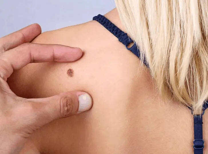 woman having mole removal Chessington consultation before treatment.
