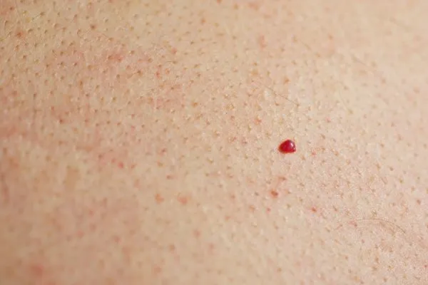 close up of a cherry angioma Chessington