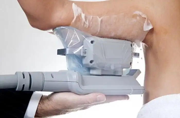 Picture of fat freezing Chessington on the upper arms.