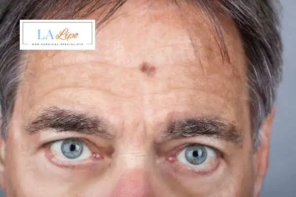 Solar Lentigo Removal Chessington image of man with mark on his forehead