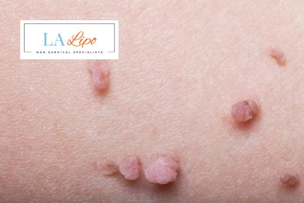 Does cryopen skin tag removal Chessington hurt? Find out now call our team today!