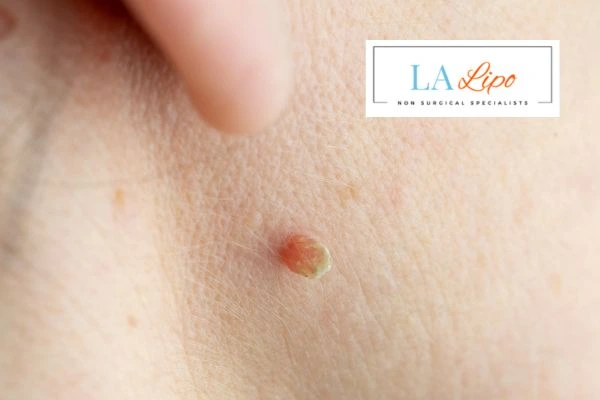 Book skin tag removal Chessington today speak to our team now!