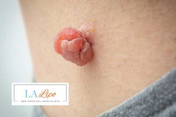 Interested in skin tag removal Chessington? Concerned about the pain? Find out more today!