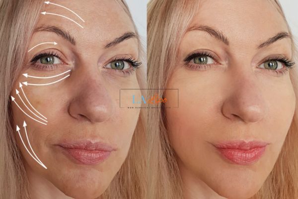 Morpheus 8 results Chessington face lift.