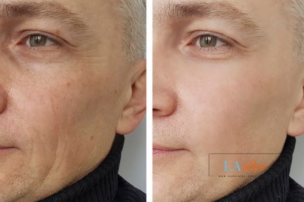 See the amazing results of Morpheus8 Treatment Chessington!