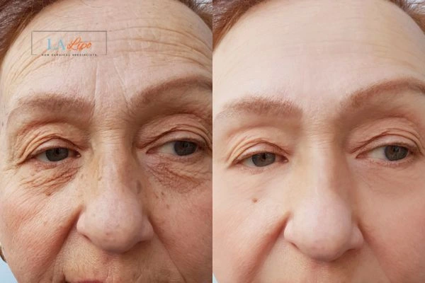 The powerful benefits of Morpheus8 Treatment Chessington - Call Our team today!