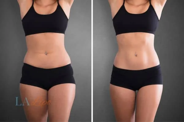 before and after results of non-surgical treatment to help a woman's body image and mental health Chessington