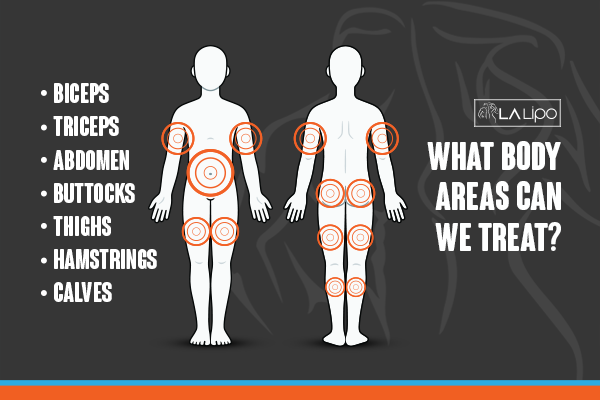 Diagram to show areas you can have LA-EMS Body Sculpting Treatment Chessington