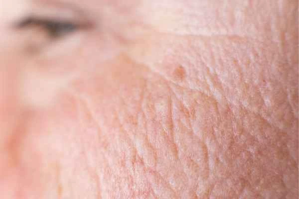 close up picture of a woman's face showing an age spot Chessington