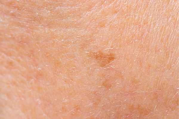 close up picture of age spots Chessington