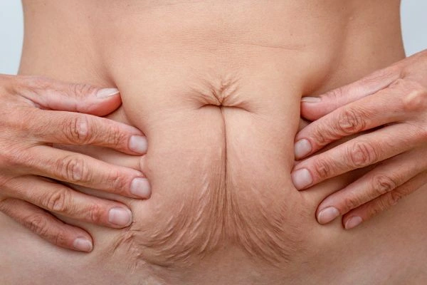Image of a woman's stomach with loose skin - example of skin tightening Chessington options