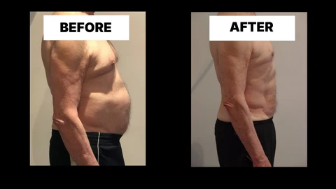 What Symptoms Can Diastasis Recti Cause in Men? Weak Core, Back Pain and Poor Posture Chessington